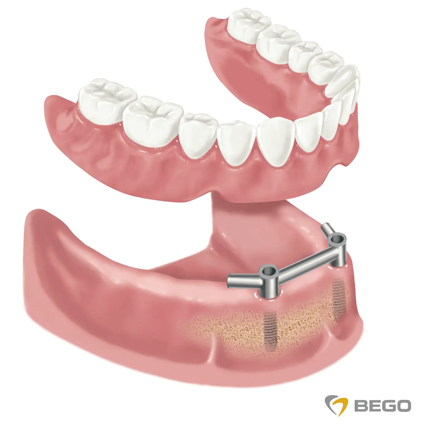 Ali veste, kako lahko rešite problem brezzobe čeljusti? | Stomatološka poliklinika Zagreb | Štimac centar dentalne medicine
