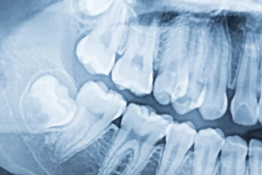 Natančna diagnostika v ordinaciji je zagotovilo za uspeh terapije | Natančna diagnoza v ordinaciji je zagotovilo uspeha vaše terapije | Stomatološka poliklinika Zagreb | Štimac centar dentalne medicine