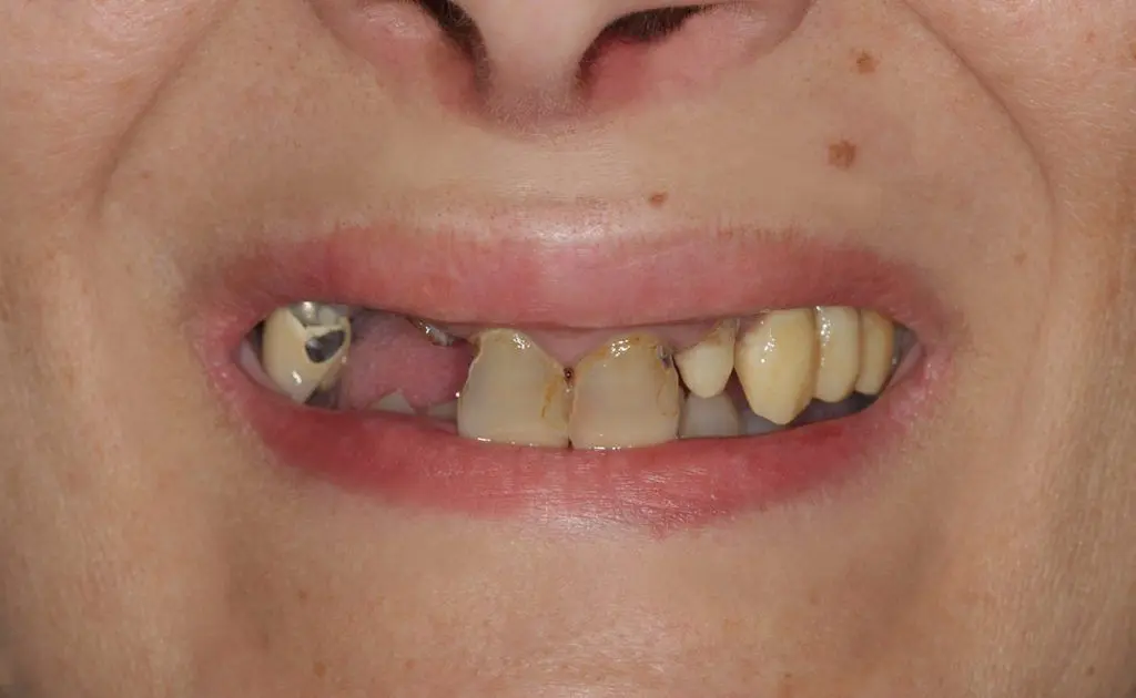 Ali veste, kako lahko rešite problem brezzobe čeljusti? | Stomatološka poliklinika Zagreb | Štimac centar dentalne medicine