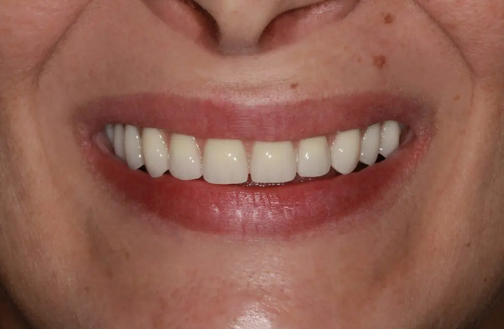 Ali veste, kako lahko rešite problem brezzobe čeljusti? | Stomatološka poliklinika Zagreb | Štimac centar dentalne medicine