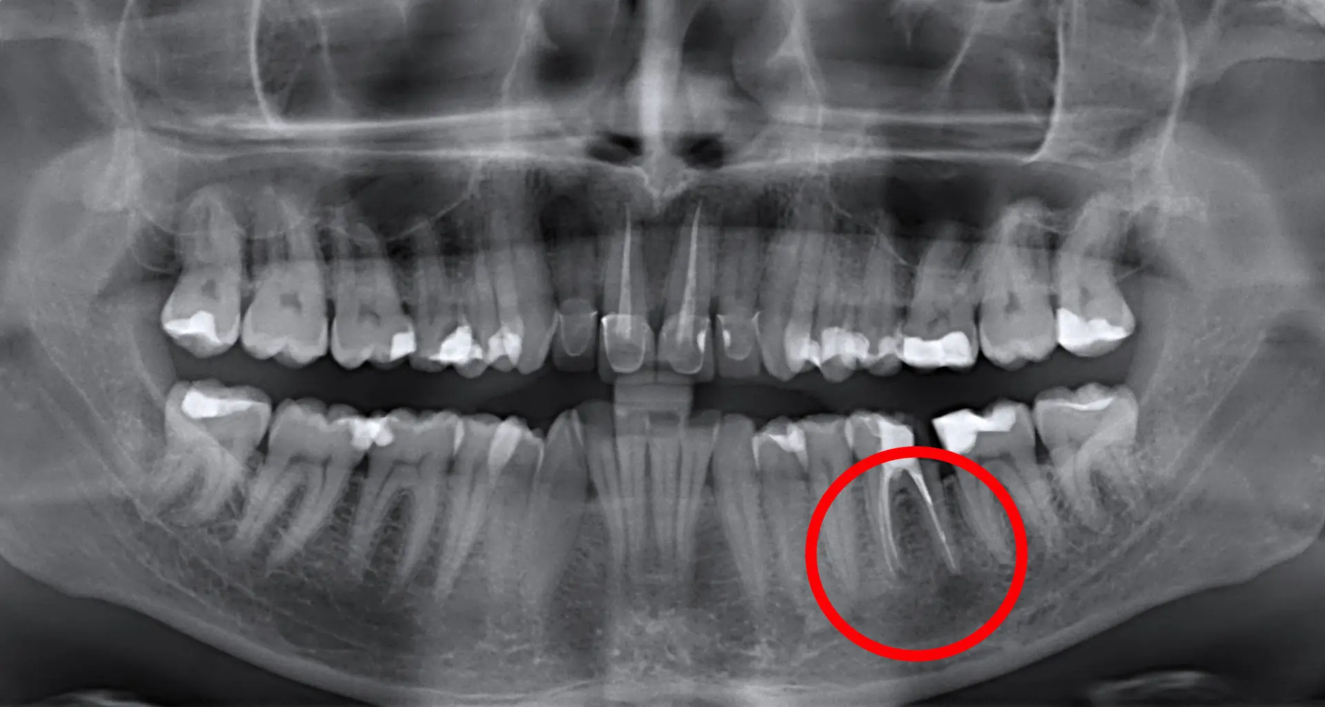 Apikotomija – kirurška odstranitev vrha korenine - Apikotomija - kirurško odstranjenje vrška korijena | Štimac centar dentalne medicine