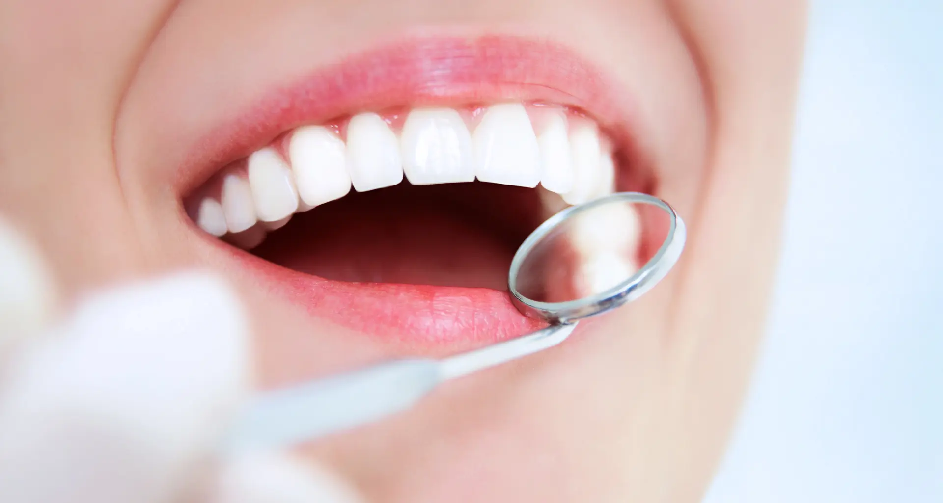 Čiščenje zobnega kamna - Čišćenje zubnog kamenca | Štimac centar dentalne medicine