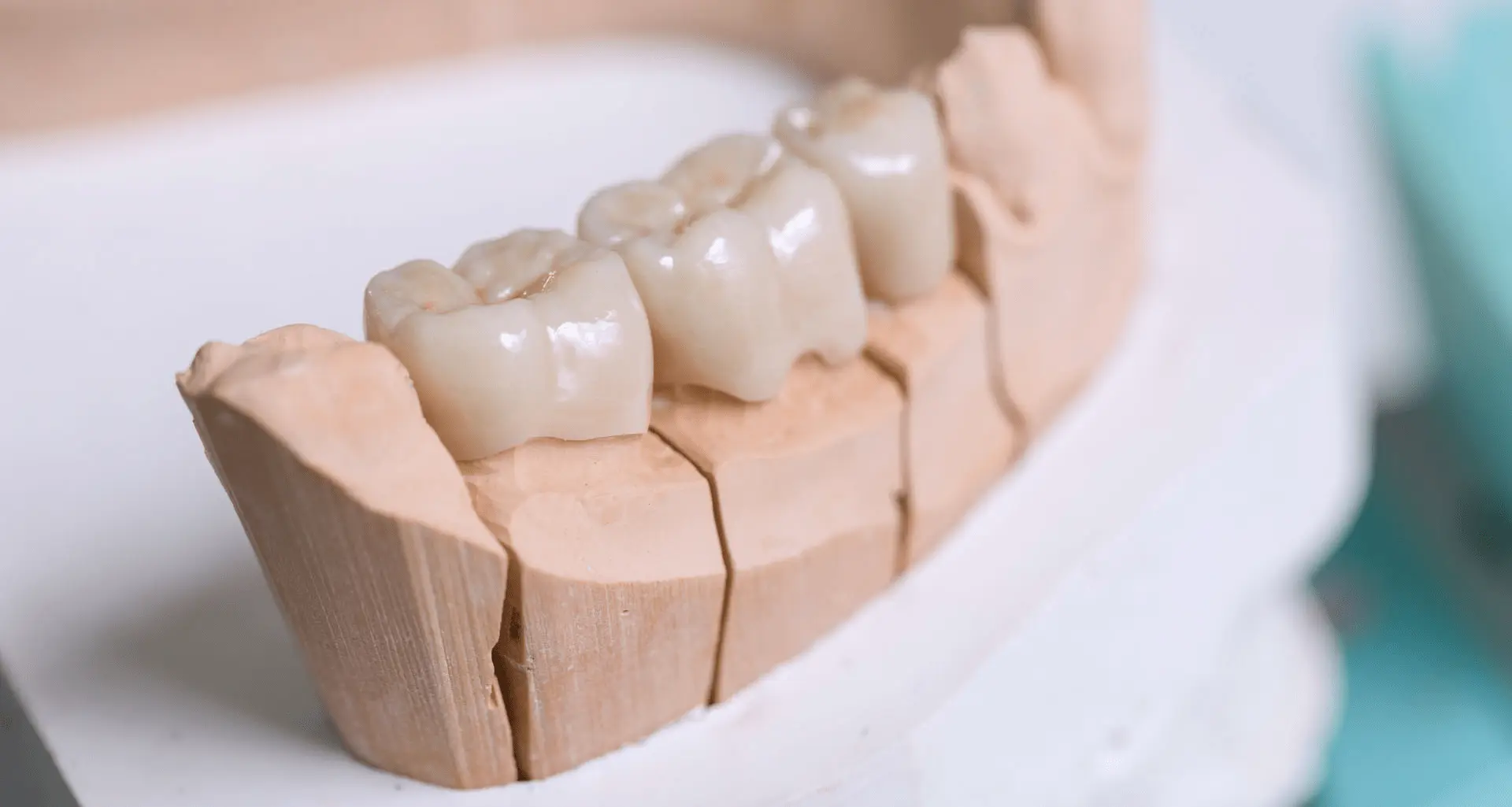 Zobne krone - Zubne krunice Zagreb | Štimac centar dentalne medicine