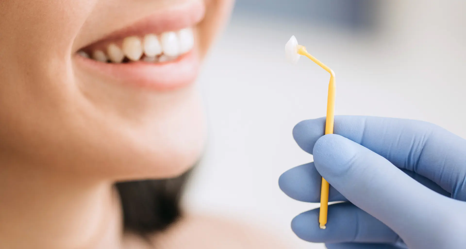 Zobne luske - Ljuskice za zube | Štimac centar dentalne medicine