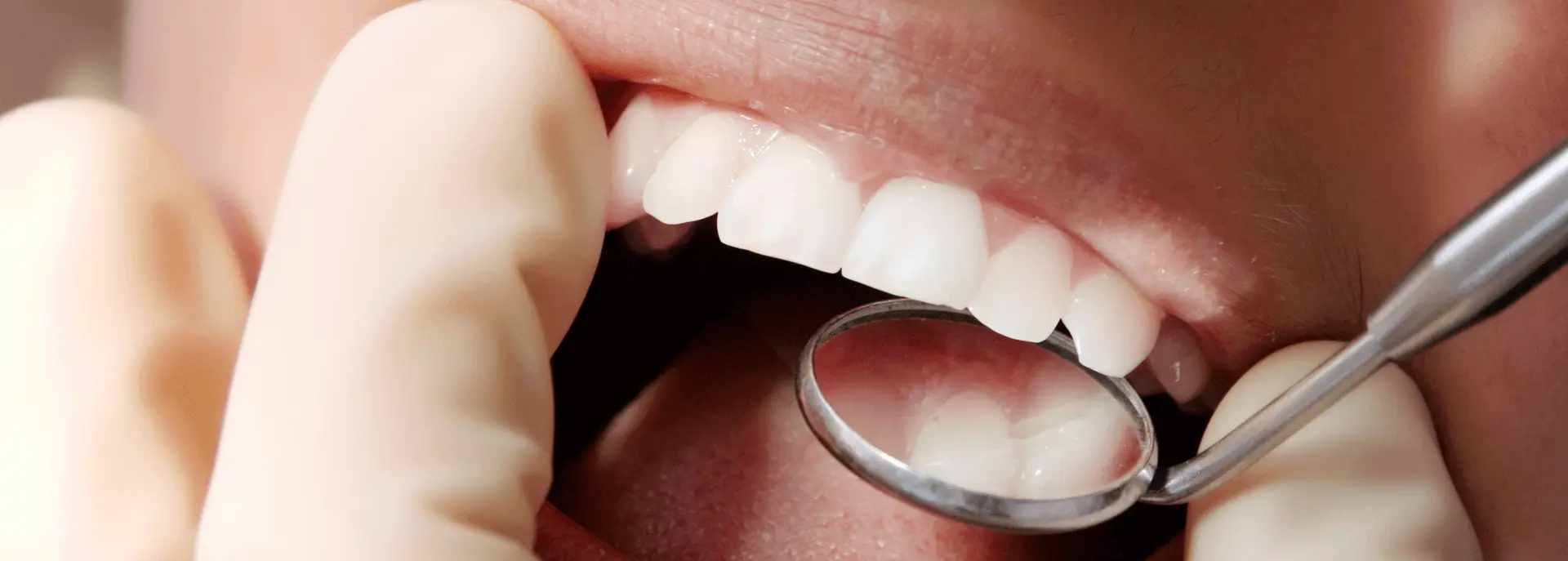 Polnitve - Ispuni | Štimac centar dentalne medicine