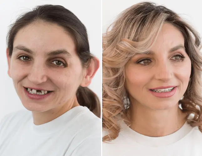 Zobne krone | Rezultati implantati #2