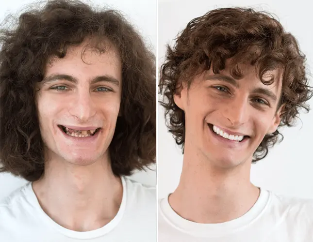 Zobne krone | Rezultati implantati #2