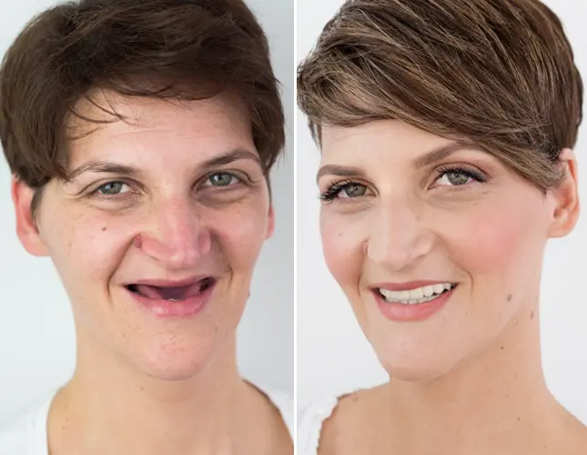 All-on-4 metoda | Dental Center Štimac | Hrvaška - Zagreb | Dentalni makeover | Štimac centar dentalne medicine