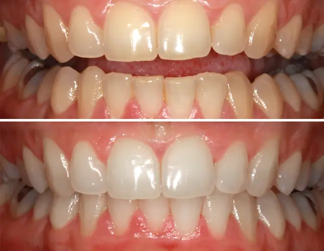 Beljenje zob | Izbjeljivanje zubi | Štimac centar dentalne medicine