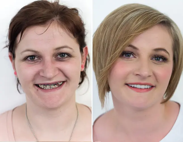 Zobne luske | Ljuskice za zube | Stomatološka poliklinika Zagreb | Štimac centar dentalne medicine