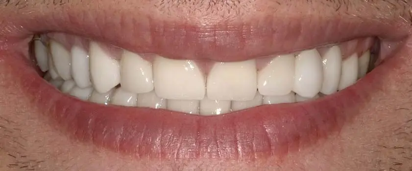 Študije primerov | Slučaj ugradnje ljuskica i krunica