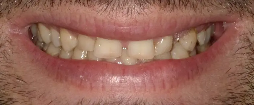 Študije primerov | Slučaj ugradnje ljuskica i krunica