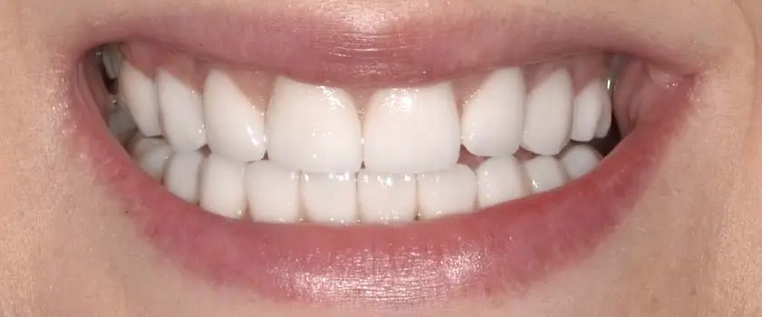 Študije primerov | Slučaj ugradnje ljuskica i krunica