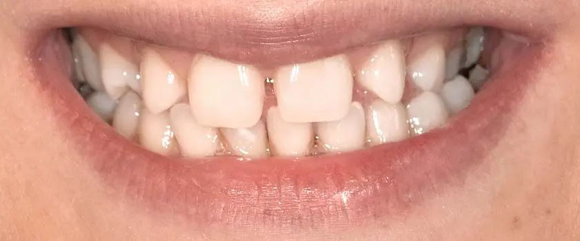 Študije primerov | Slučaj ugradnje ljuskica i krunica