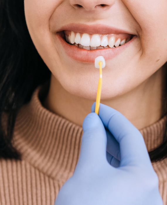 Zobne luske | Ljuskice za zube | Stomatološka poliklinika Zagreb | Štimac centar dentalne medicine