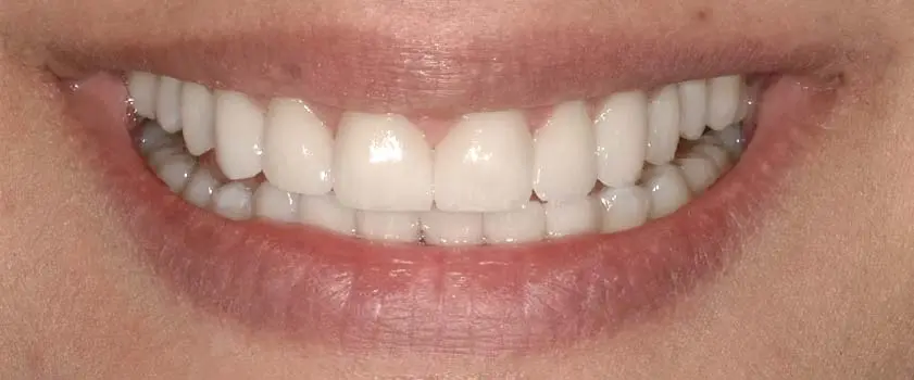 Študije primerov | Slučaj ugradnje ljuskica i krunica