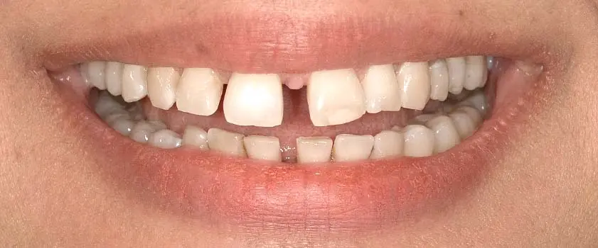 Študije primerov | Slučaj ugradnje ljuskica i krunica