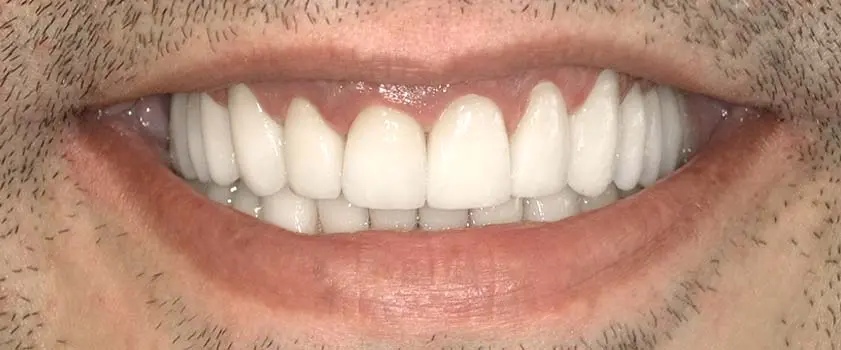 Študije primerov | Slučaj ugradnje implantata, mostova i krunica