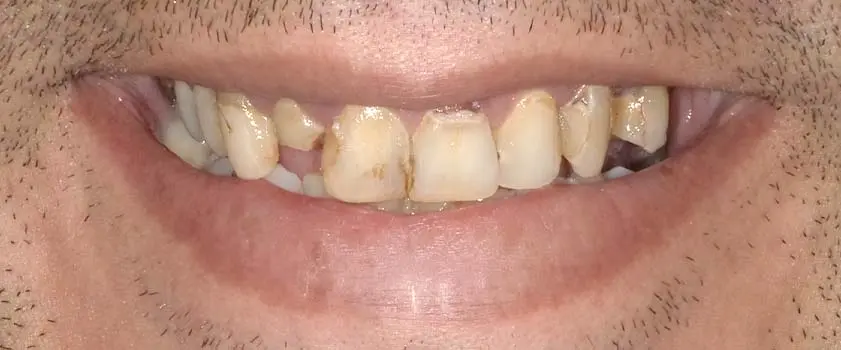 Študije primerov | Slučaj ugradnje implantata, mostova i krunica