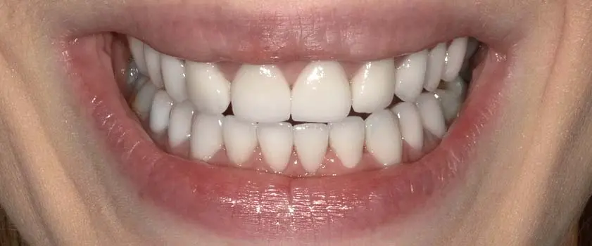 Študije primerov | Slučaj ugradnje ljuskica i krunica