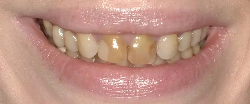 Študije primerov | Slučaj ugradnje ljuskica i krunica