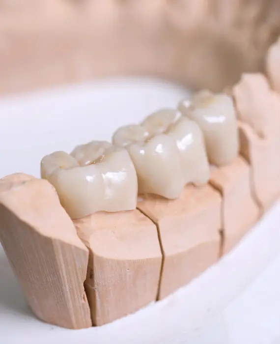 Zobna protetika | Zubna protetika | Stomatološka poliklinika Zagreb | Štimac centar dentalne medicine