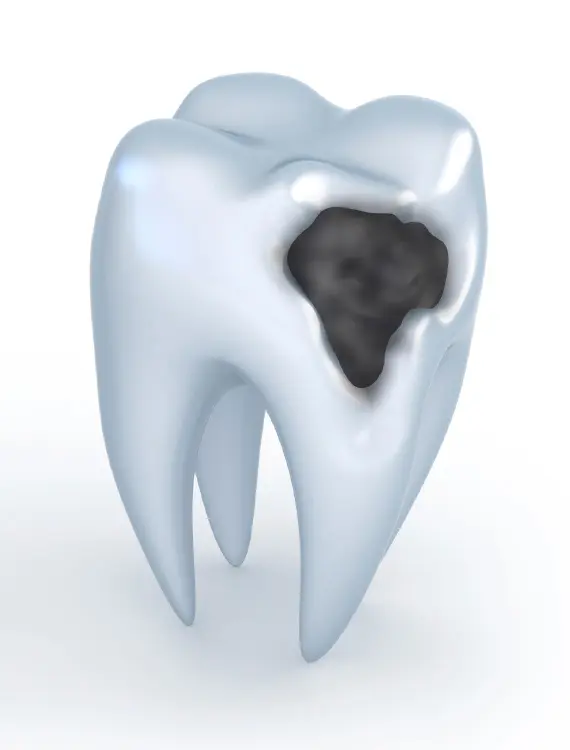 Polnitve | ŠTO JE KARIJES?