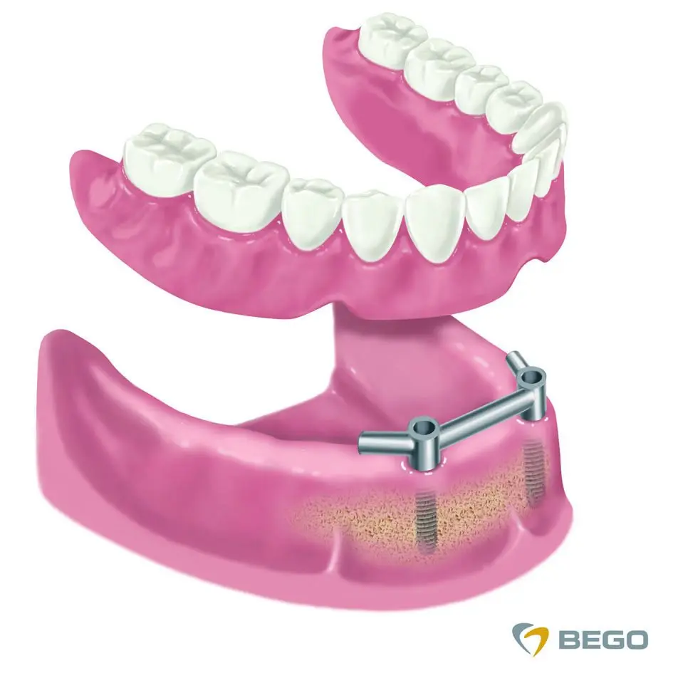 Zobna protetika | Zubna protetika | Stomatološka poliklinika Zagreb | Štimac centar dentalne medicine
