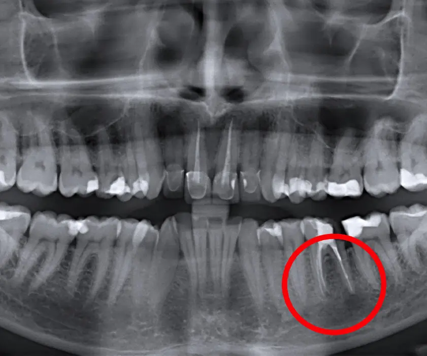 Oralna kirurgija | Stomatološka poliklinika Zagreb | Štimac centar dentalne medicine