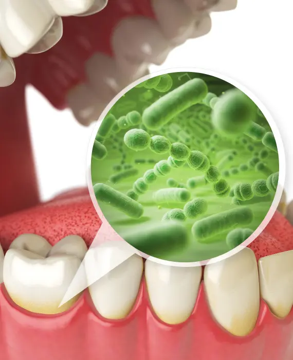 Čiščenje zobnega kamna | Čišćenje zubnog kamenca | Čiščenje zobnega kamna | ZAŠTO ČISTITI ZUBNI KAMENAC?