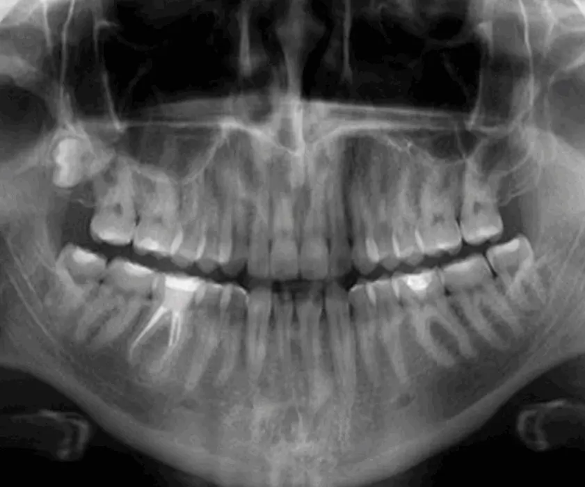 Cistektomija | SAVRŠENE I PUNE USNE?