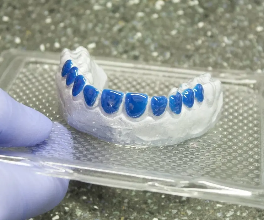 Beljenje zob | Izbjeljivanje udlagama | Štimac centar dentalne medicine