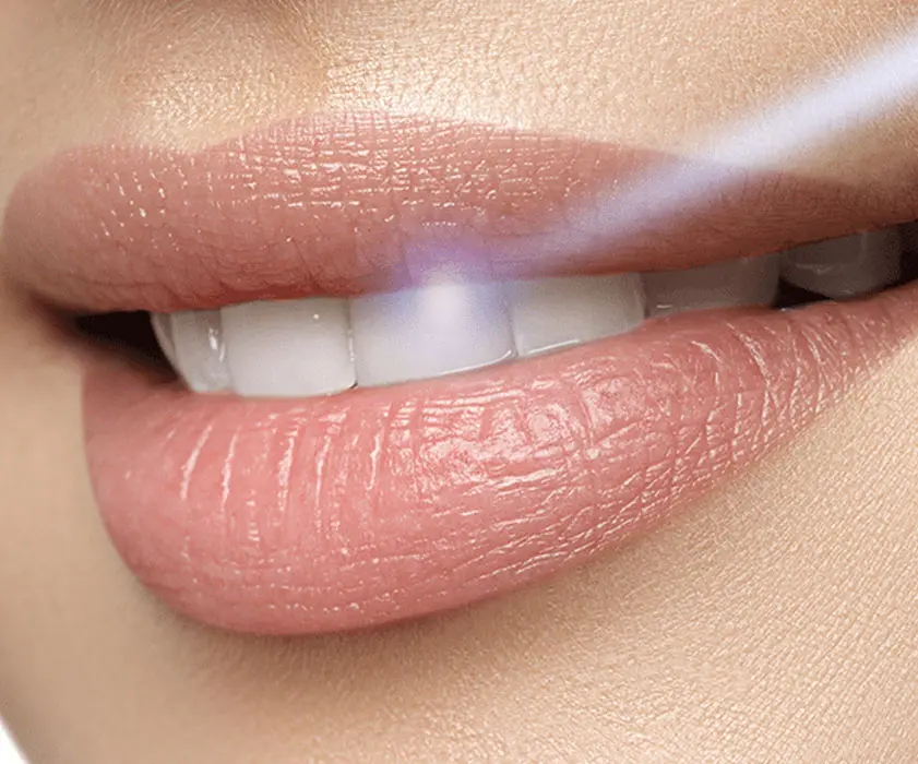 Beljenje zob | Izbjeljivanje zoom lampom | Štimac centar dentalne medicine