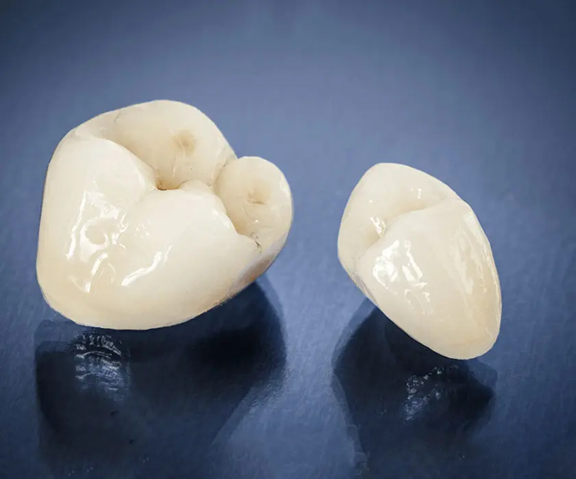 Zobne krone | Stomatološka poliklinika Zagreb | Štimac centar dentalne medicine