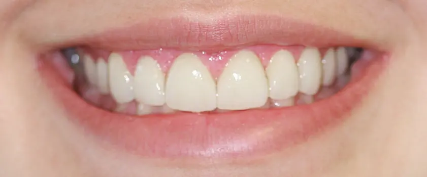 Študije primerov | PORCULANSKE LJUSKICE ZA ZUBE