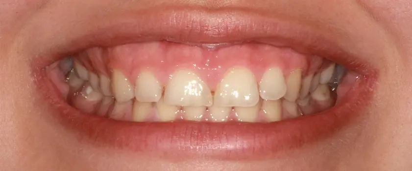 Študije primerov | PORCULANSKE LJUSKICE ZA ZUBE