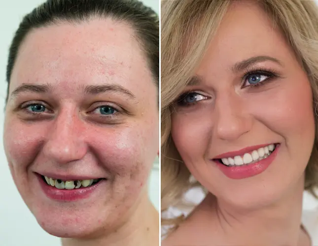 Zobne luske | Ljuskice za zube | Stomatološka poliklinika Zagreb | Štimac centar dentalne medicine