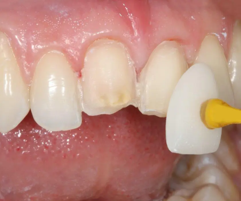 Zobotehnični laboratorij | LJUSKICE ZA ZUBE