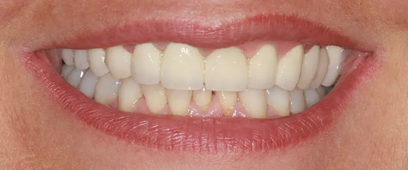 Študije primerov | ZUBNI MOSTOVI