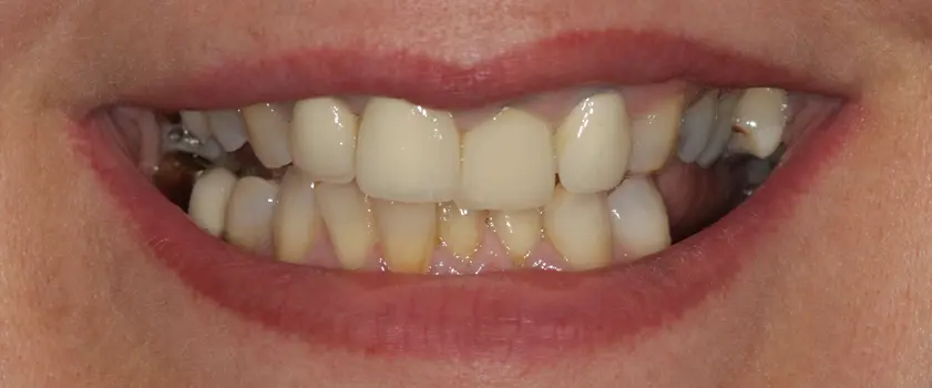 Študije primerov | ZUBNI MOSTOVI