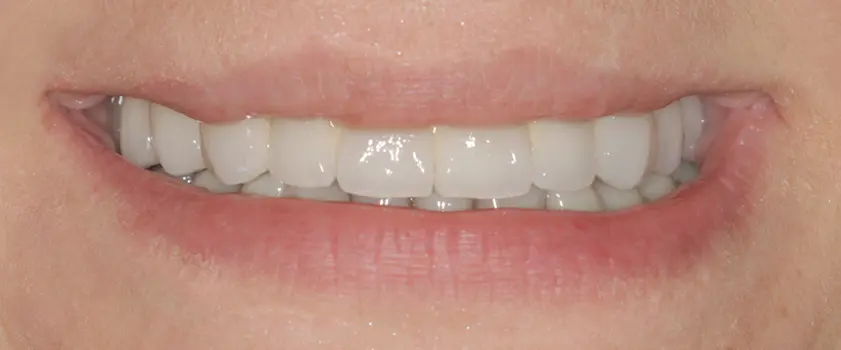 Študije primerov | IMPLANTATI