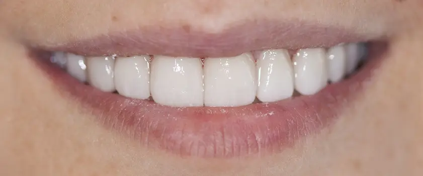 Študije primerov | IZBJELJIVANJE ZUBI