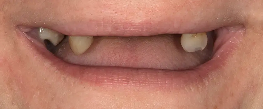 Študije primerov | IMPLANTATI