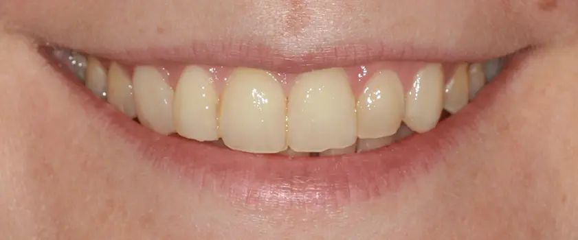 Študije primerov | IZBJELJIVANJE ZUBI