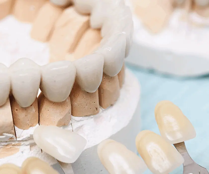 Zobni mostički | Zubni mostovi | Stomatološka poliklinika Zagreb | Štimac centar dentalne medicine